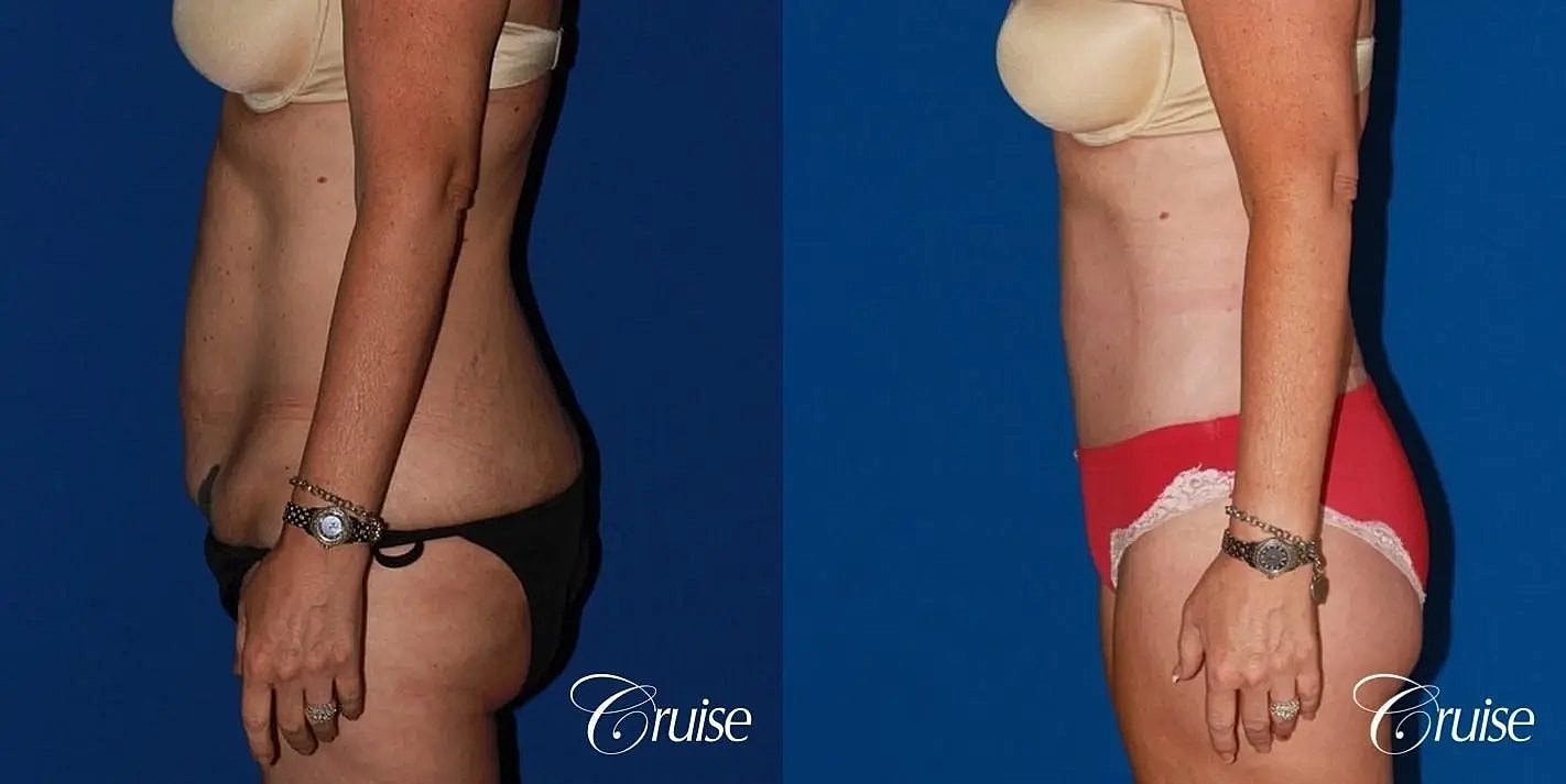 Tummy Tuck Before & After