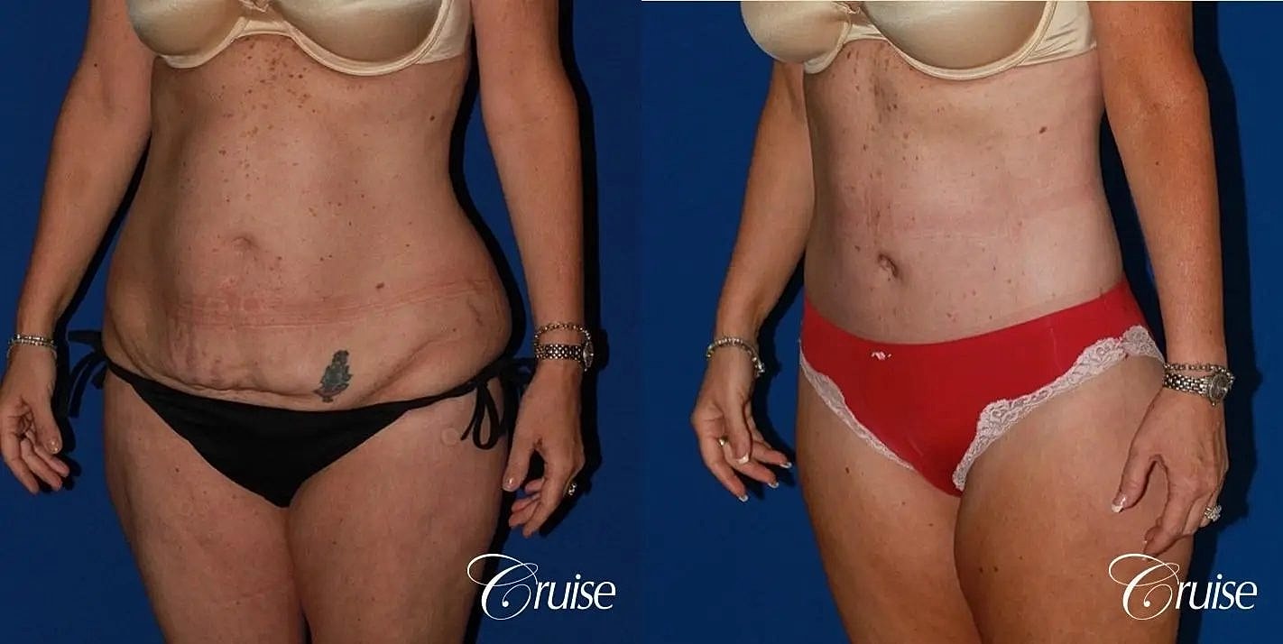 Tummy Tuck Before & After