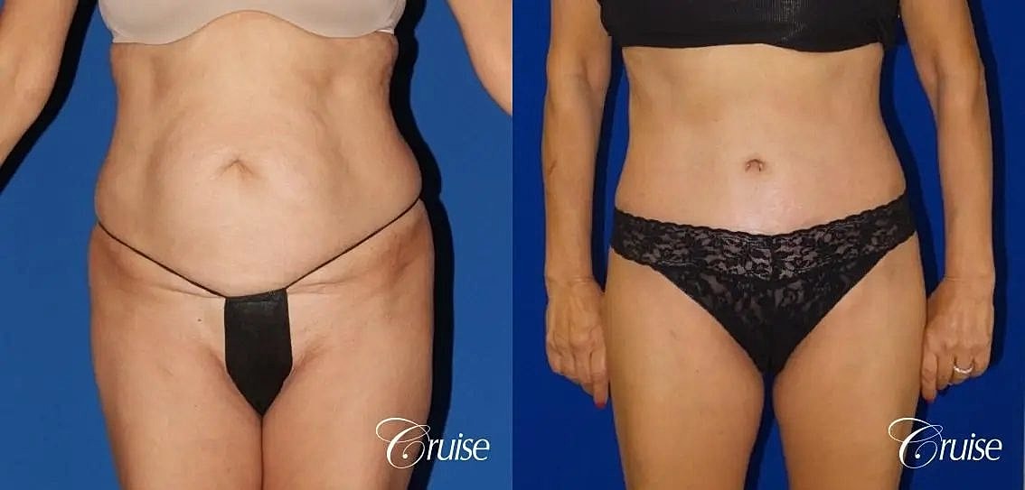 Tummy Tuck Before & After