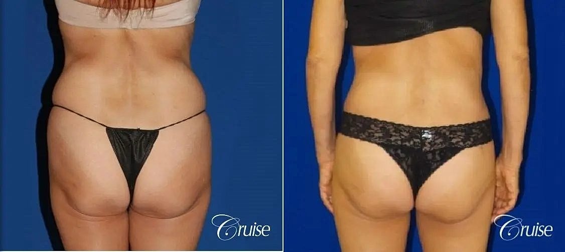 Tummy Tuck Before & After