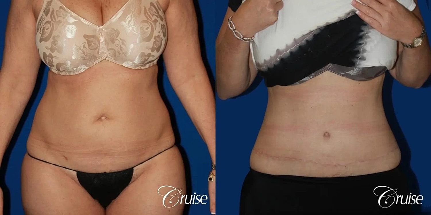 Tummy Tuck Before & After