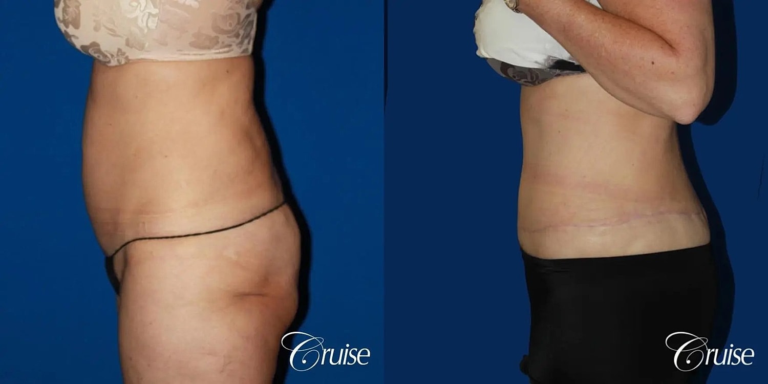 Tummy Tuck Before & After