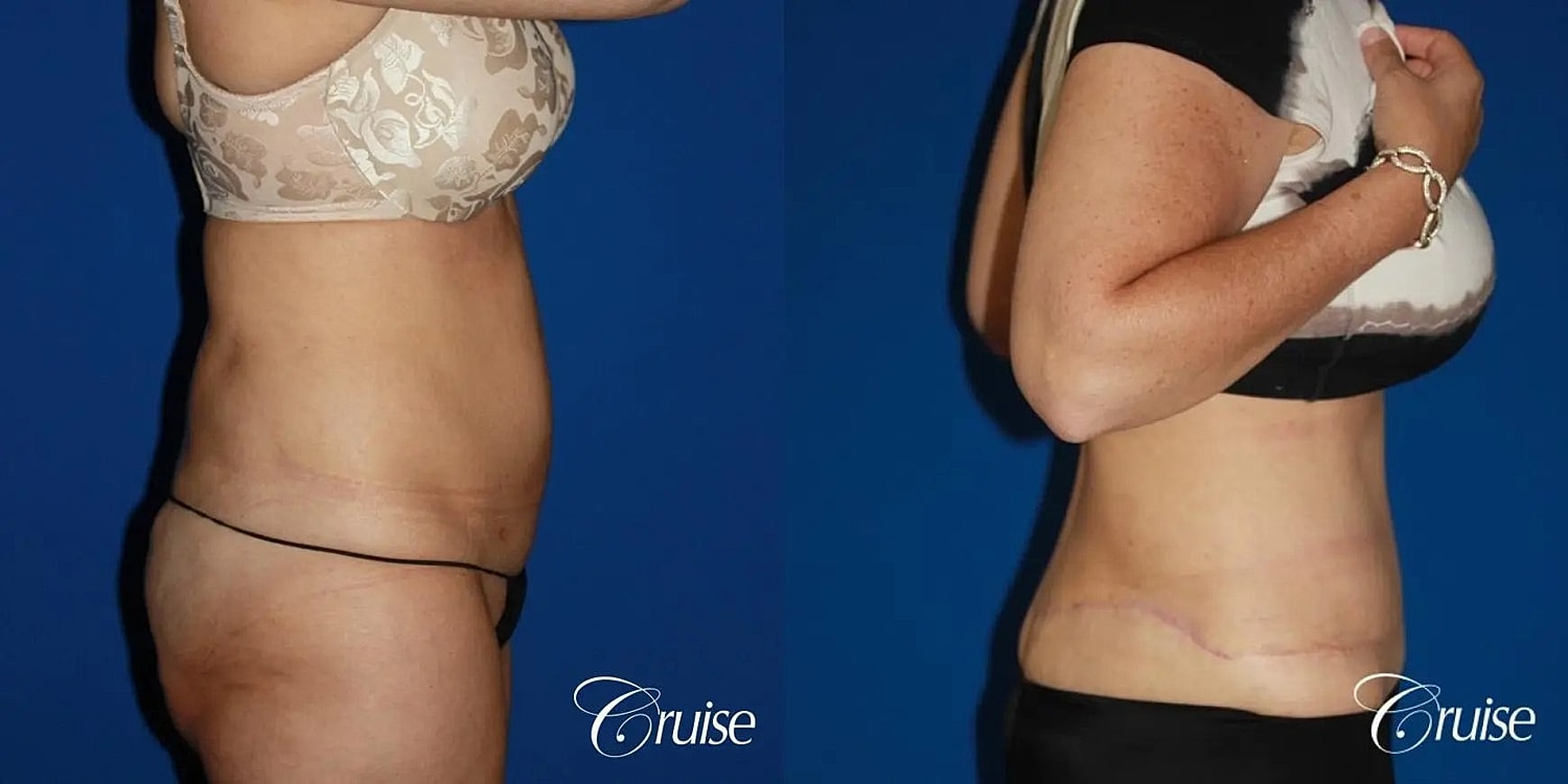 Tummy Tuck Before & After