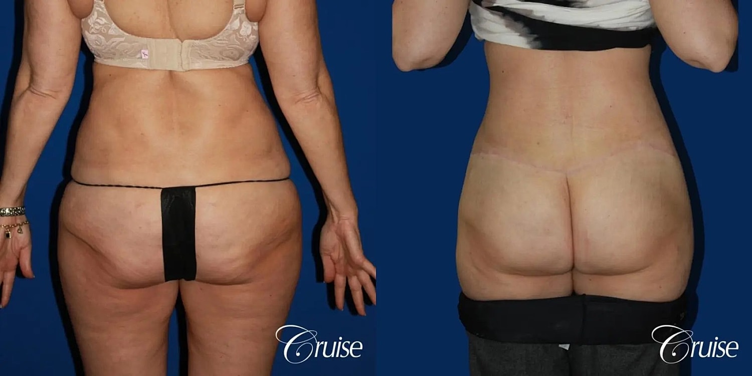 Tummy Tuck Before & After