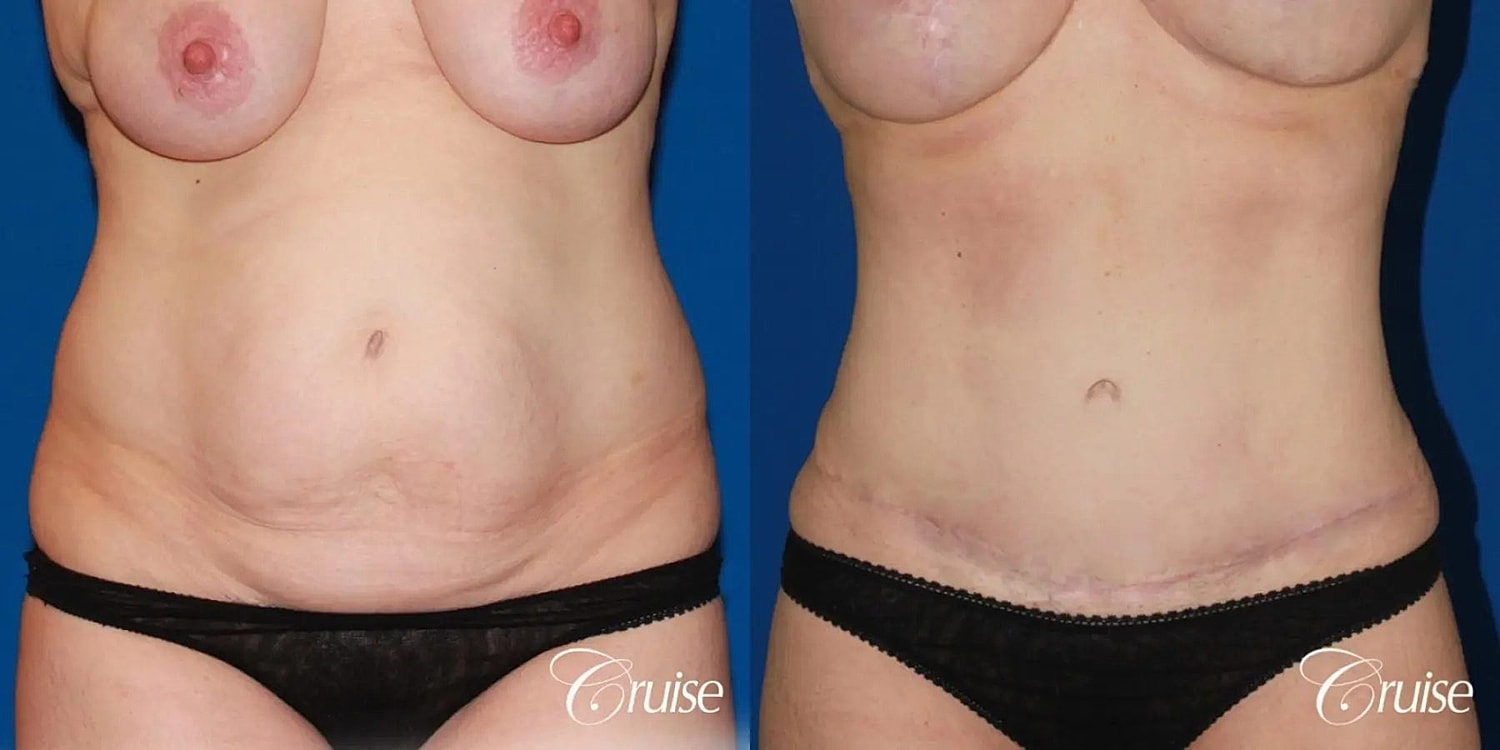 Tummy Tuck Before & After