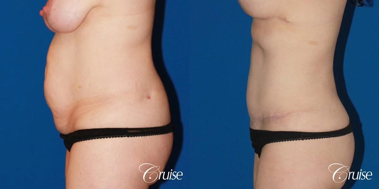 Tummy Tuck Before & After