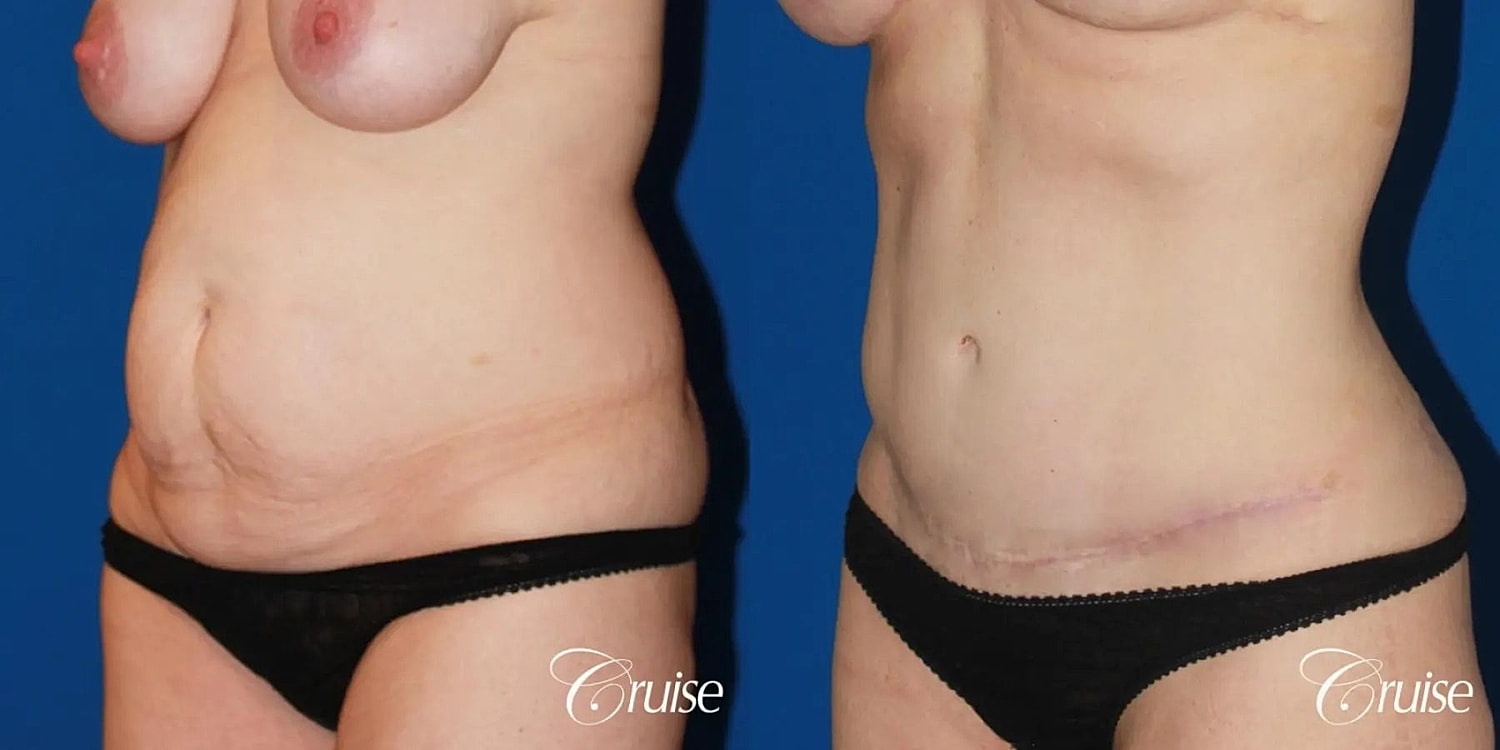 Tummy Tuck Before & After