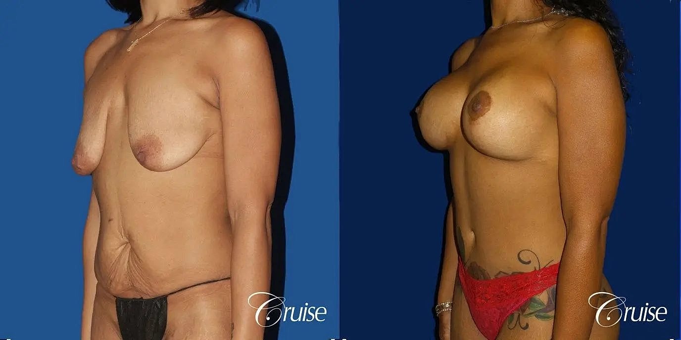 Tummy Tuck Before & After