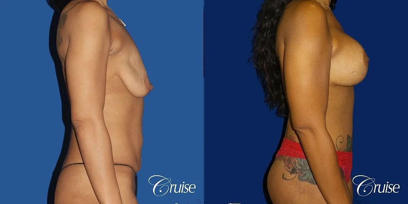 Tummy Tuck Before & After