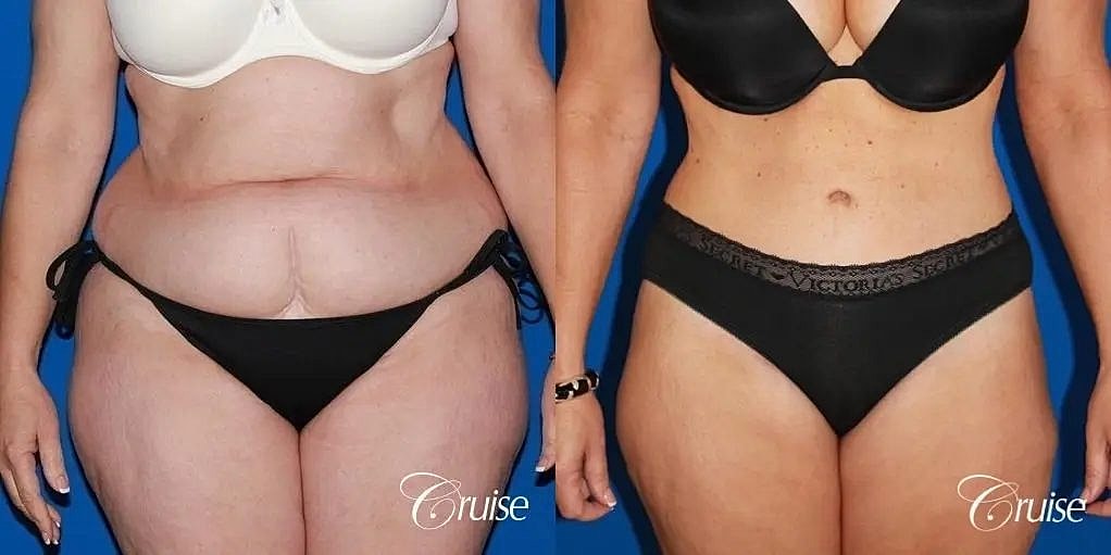 Tummy Tuck Before & After