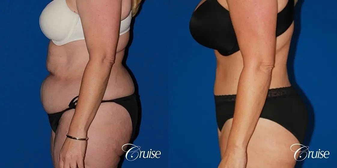 Tummy Tuck Before & After