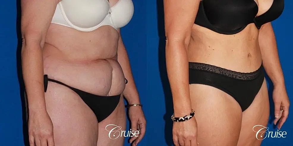 Tummy Tuck Before & After
