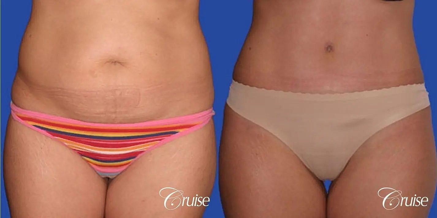 Tummy Tuck Before & After