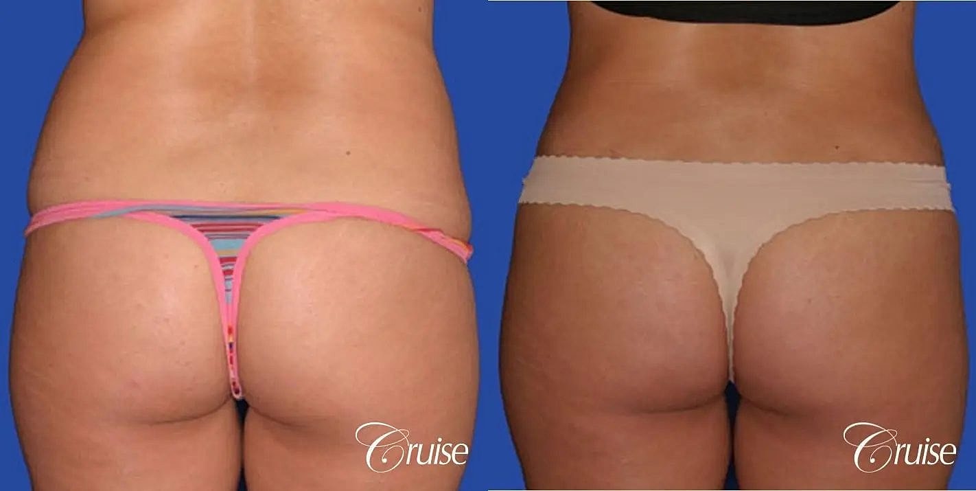 Tummy Tuck Before & After