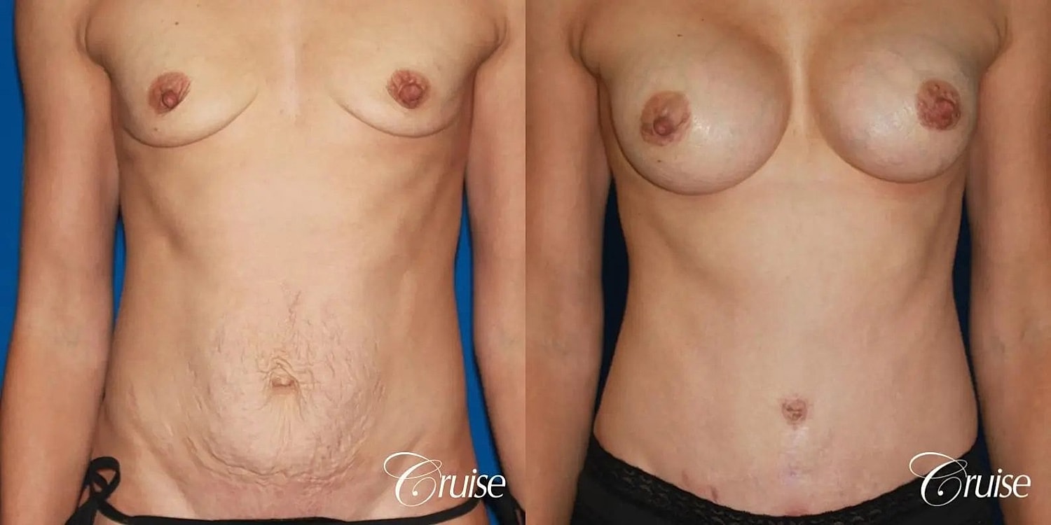 Tummy Tuck Before & After