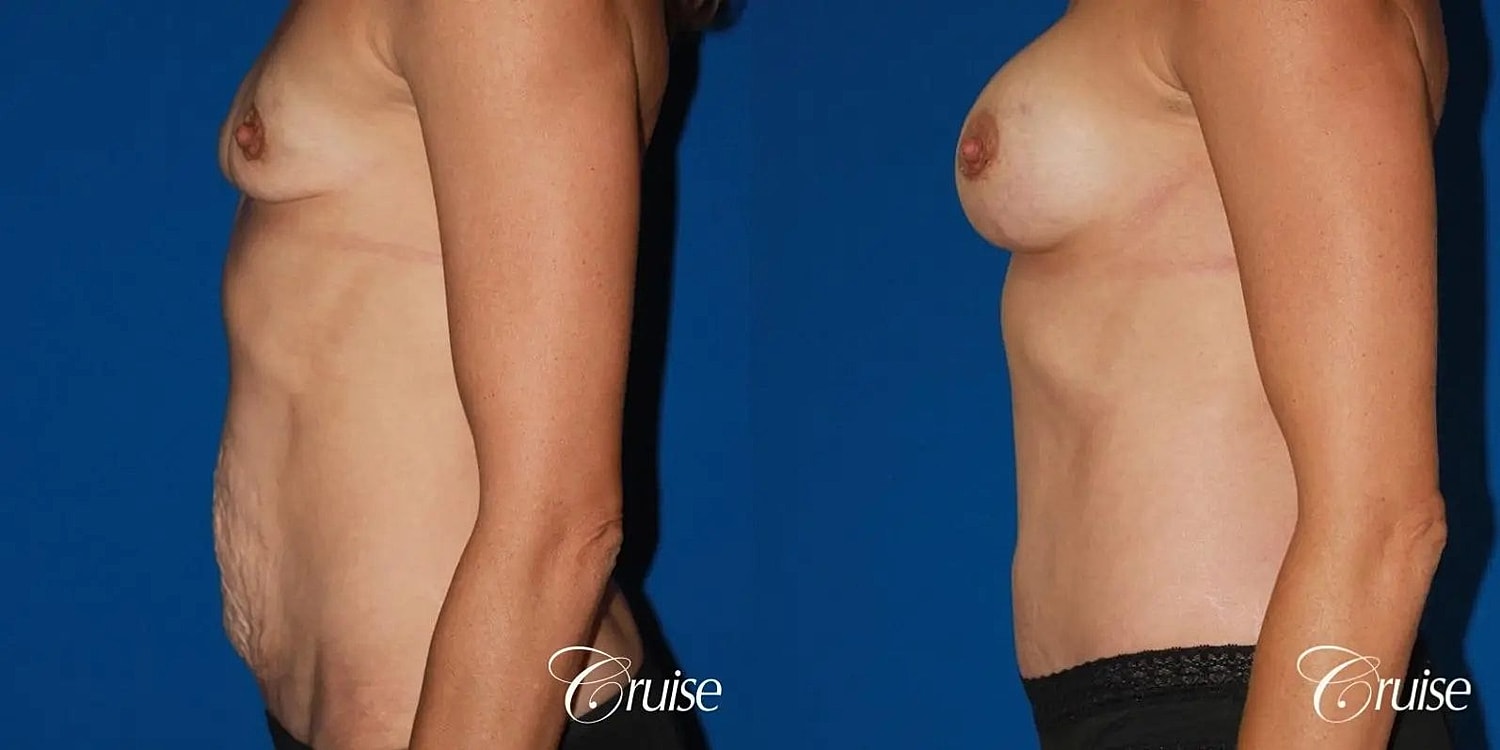 Tummy Tuck Before & After