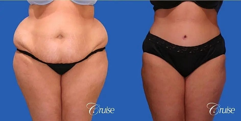 Tummy Tuck Before & After