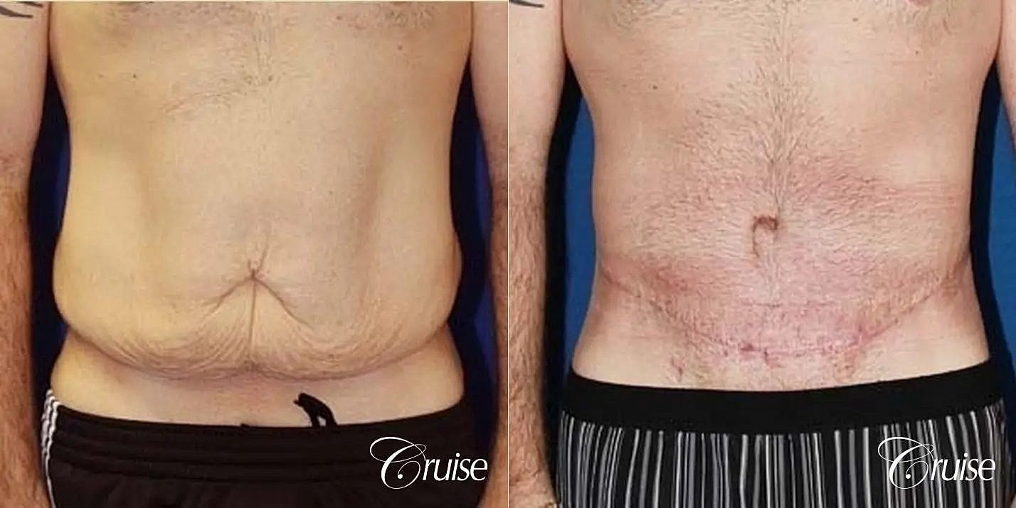 Tummy Tuck Before & After