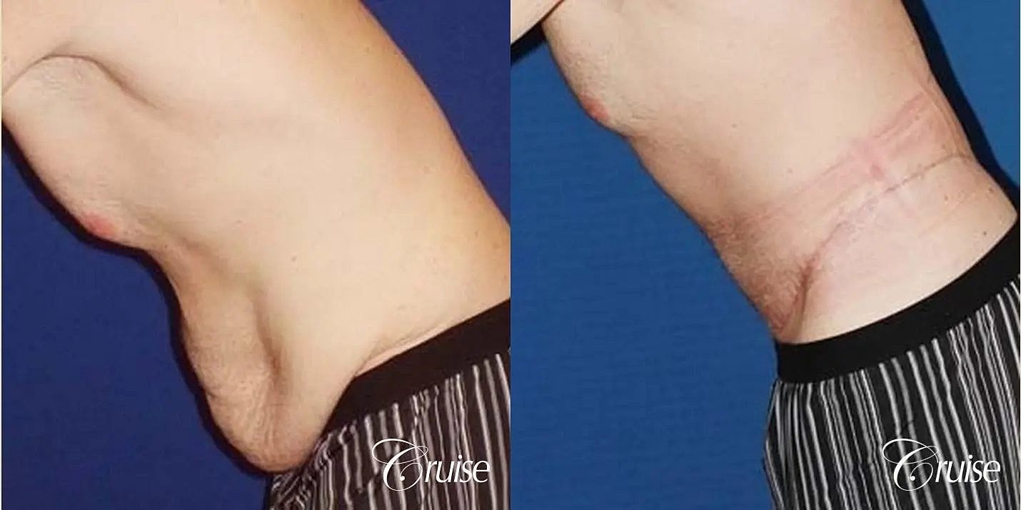 Tummy Tuck Before & After