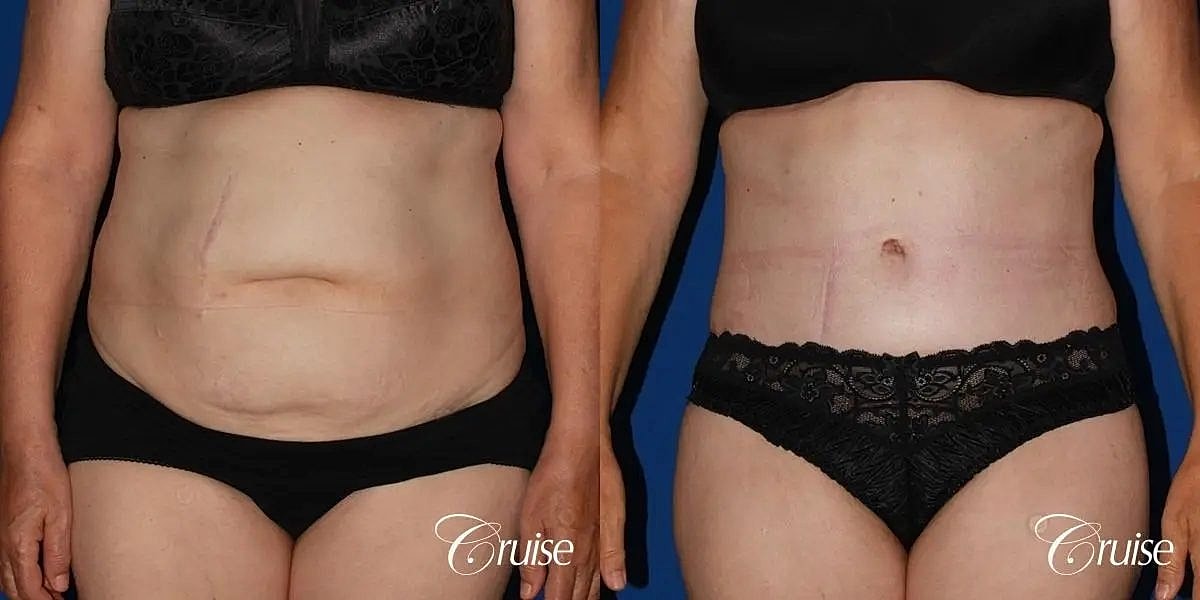 Tummy Tuck Before & After