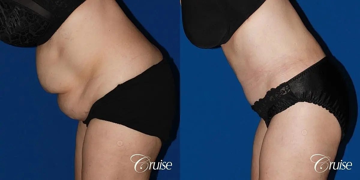 Tummy Tuck Before & After