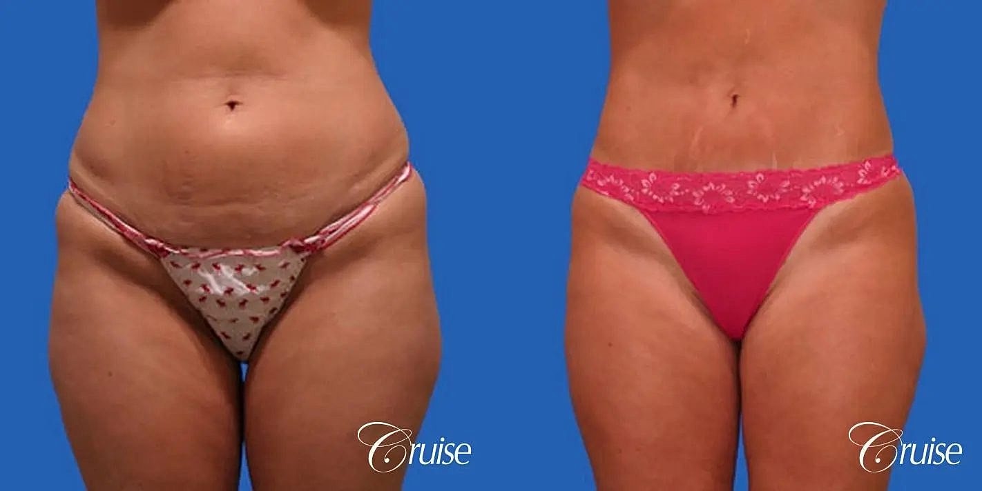 Tummy Tuck Before & After