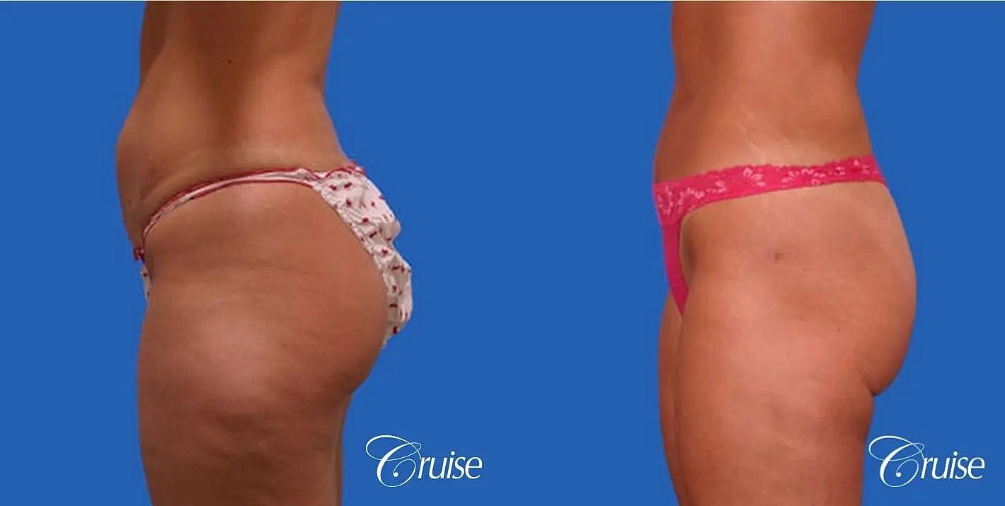 Tummy Tuck Before & After