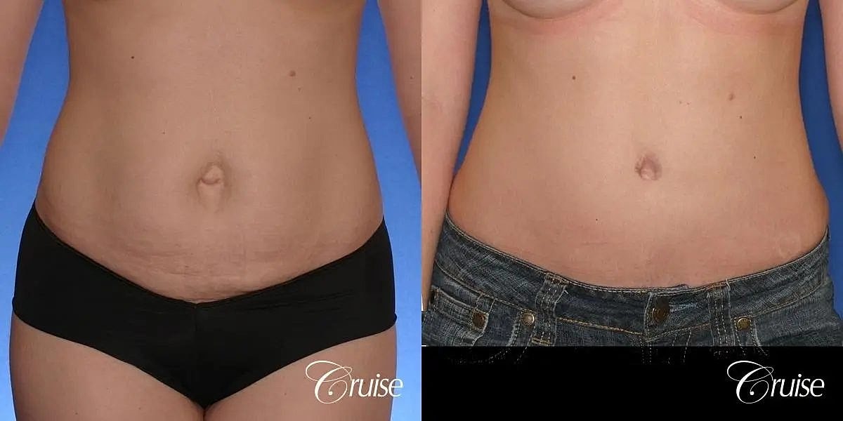 Tummy Tuck Before & After