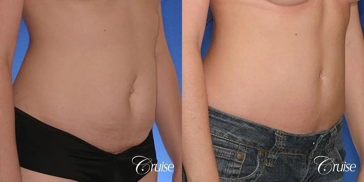 Tummy Tuck Before & After
