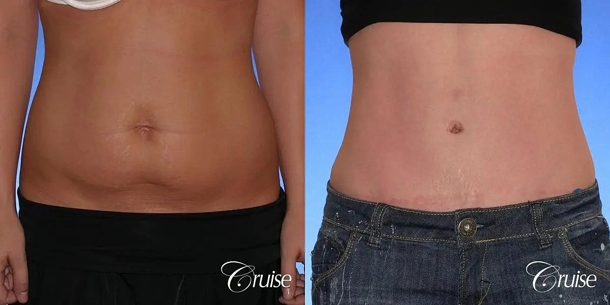 Tummy Tuck Before & After