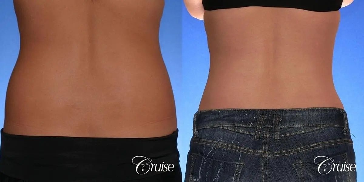 Tummy Tuck Before & After