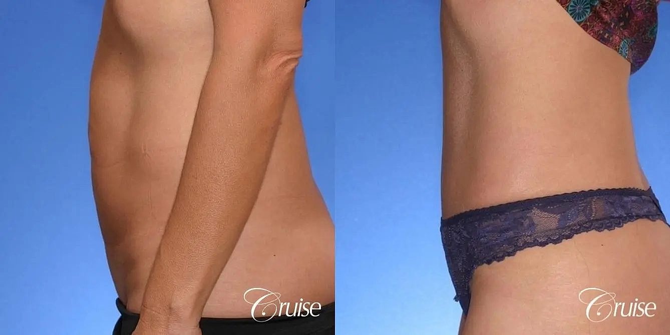 Tummy Tuck Before & After