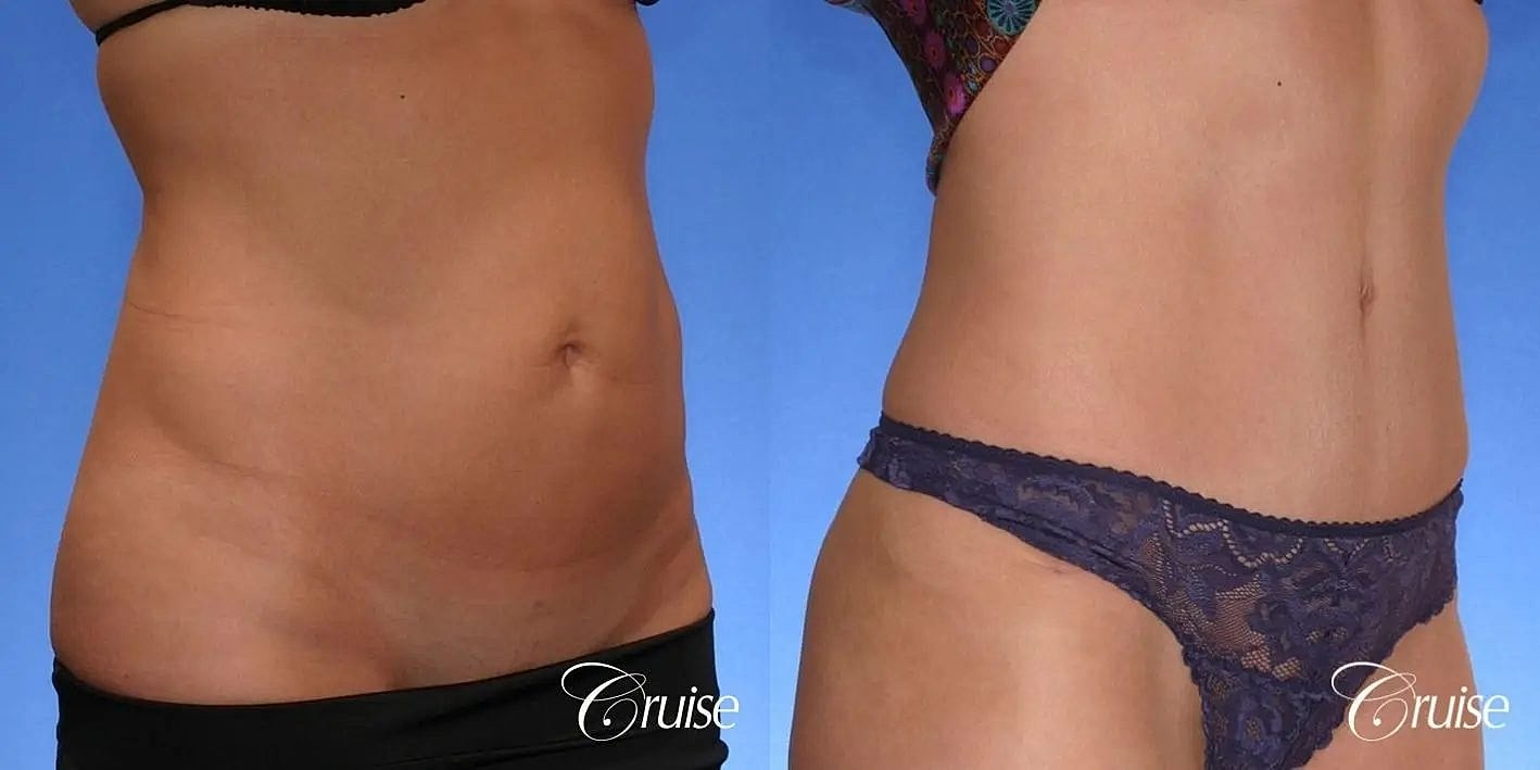 Tummy Tuck Before & After