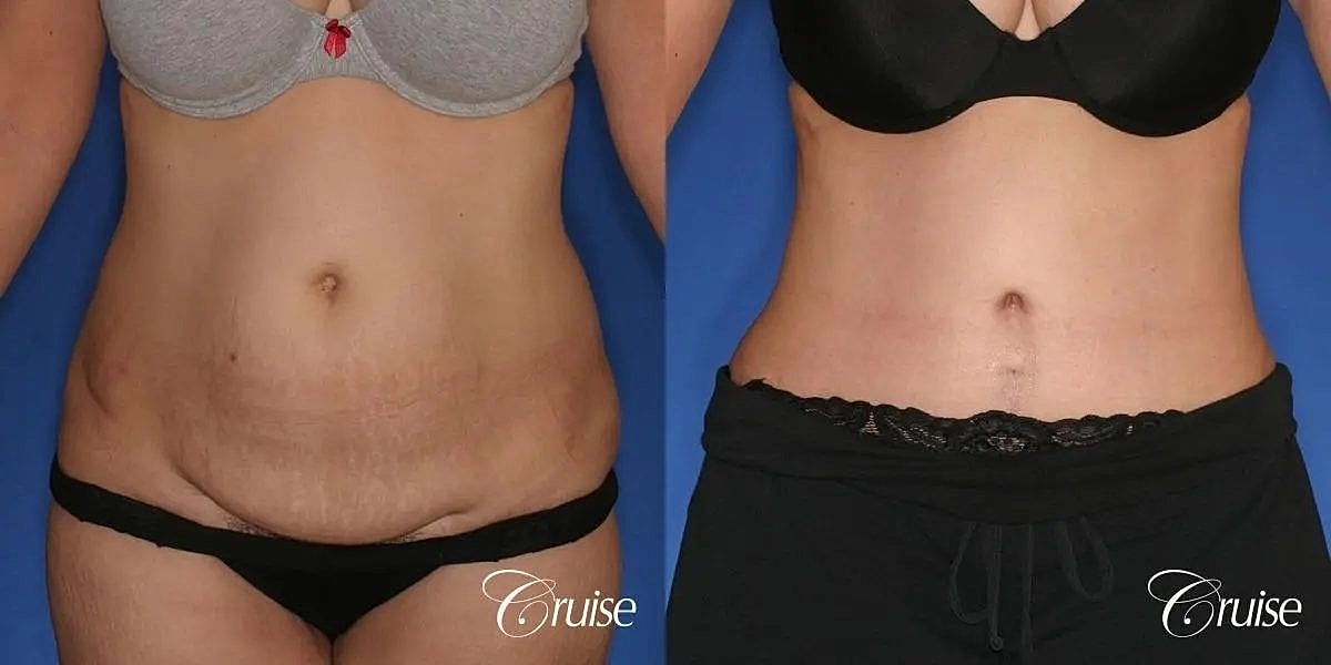 Tummy Tuck Before & After