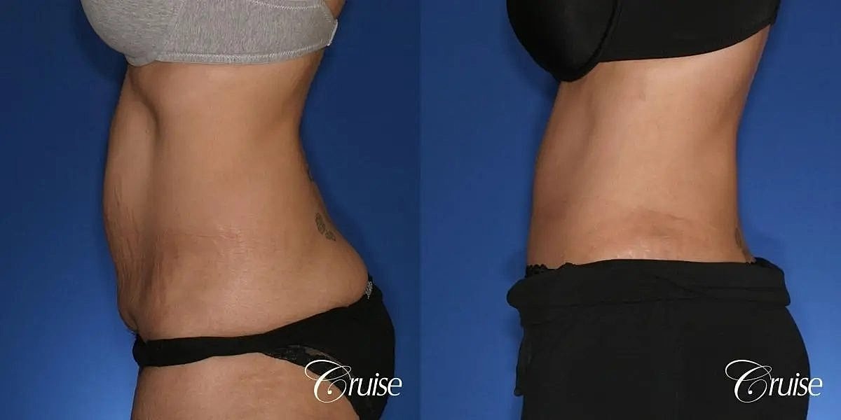 Tummy Tuck Before & After
