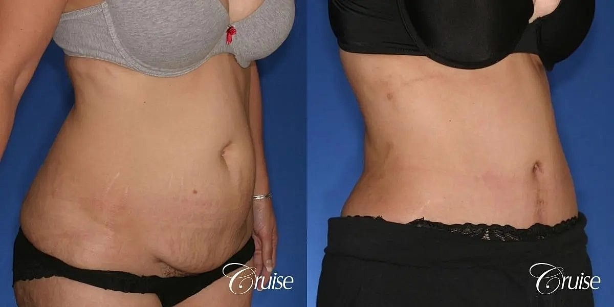 Tummy Tuck Before & After