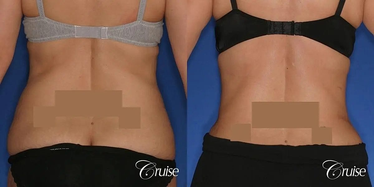 Tummy Tuck Before & After