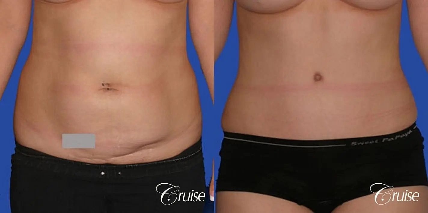 Tummy Tuck Before & After