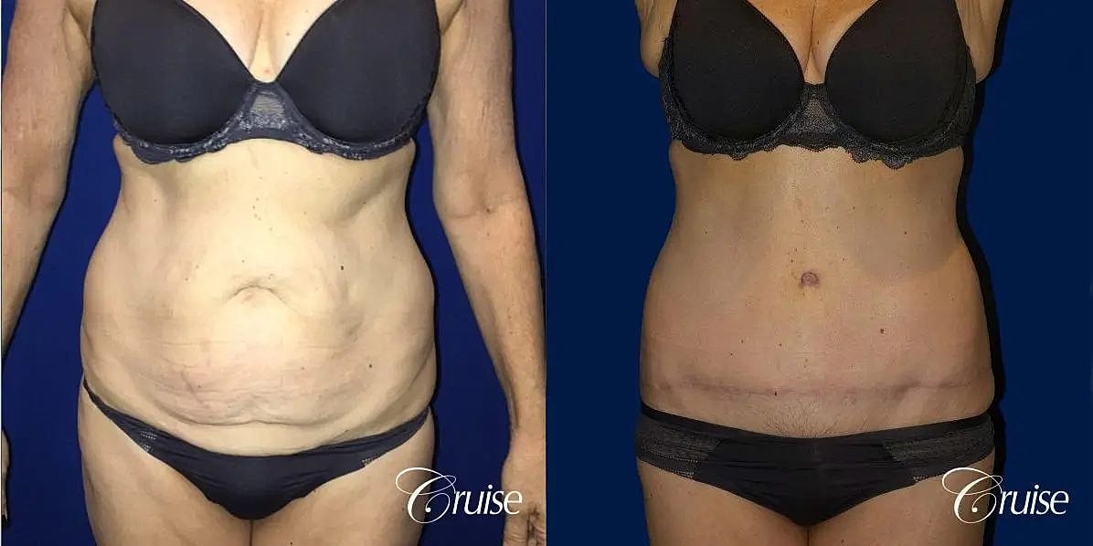 Tummy Tuck Before & After