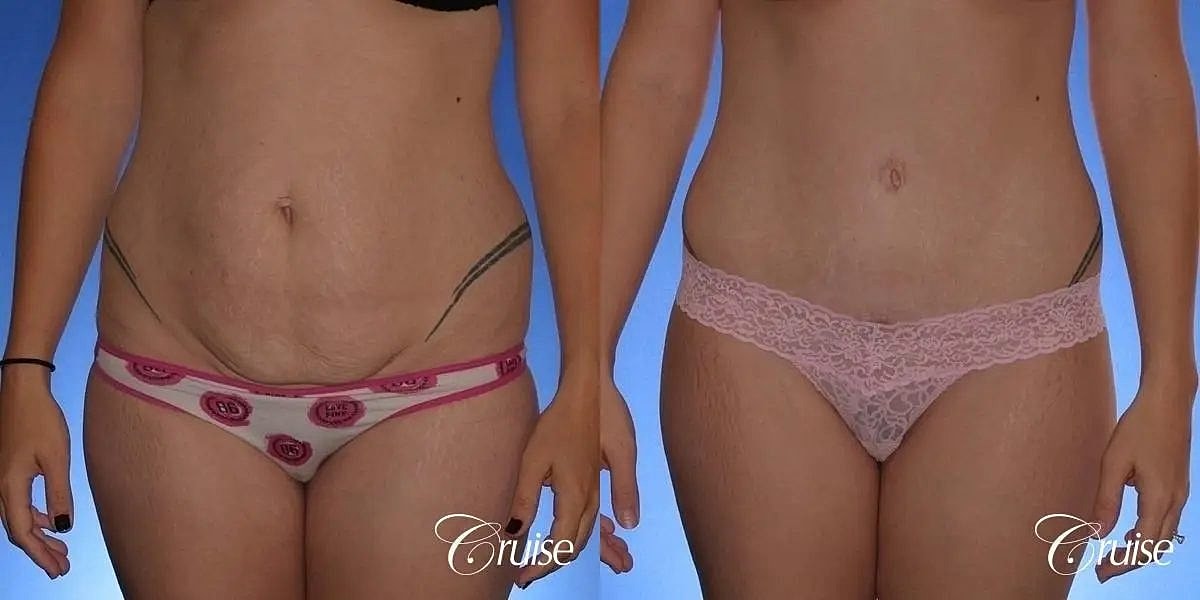 Tummy Tuck Before & After