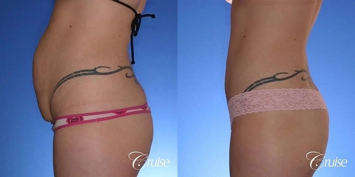 Tummy Tuck Before & After