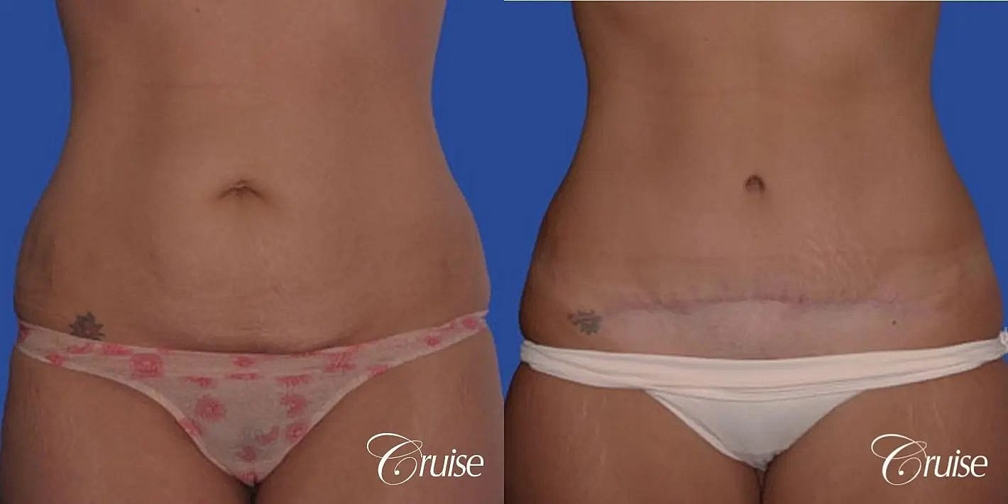 Tummy Tuck Before & After