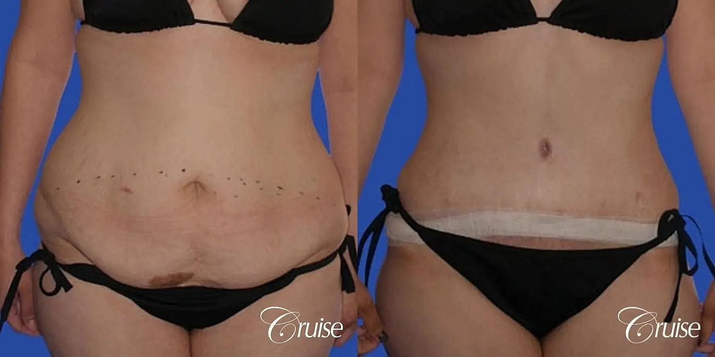 Tummy Tuck Before & After