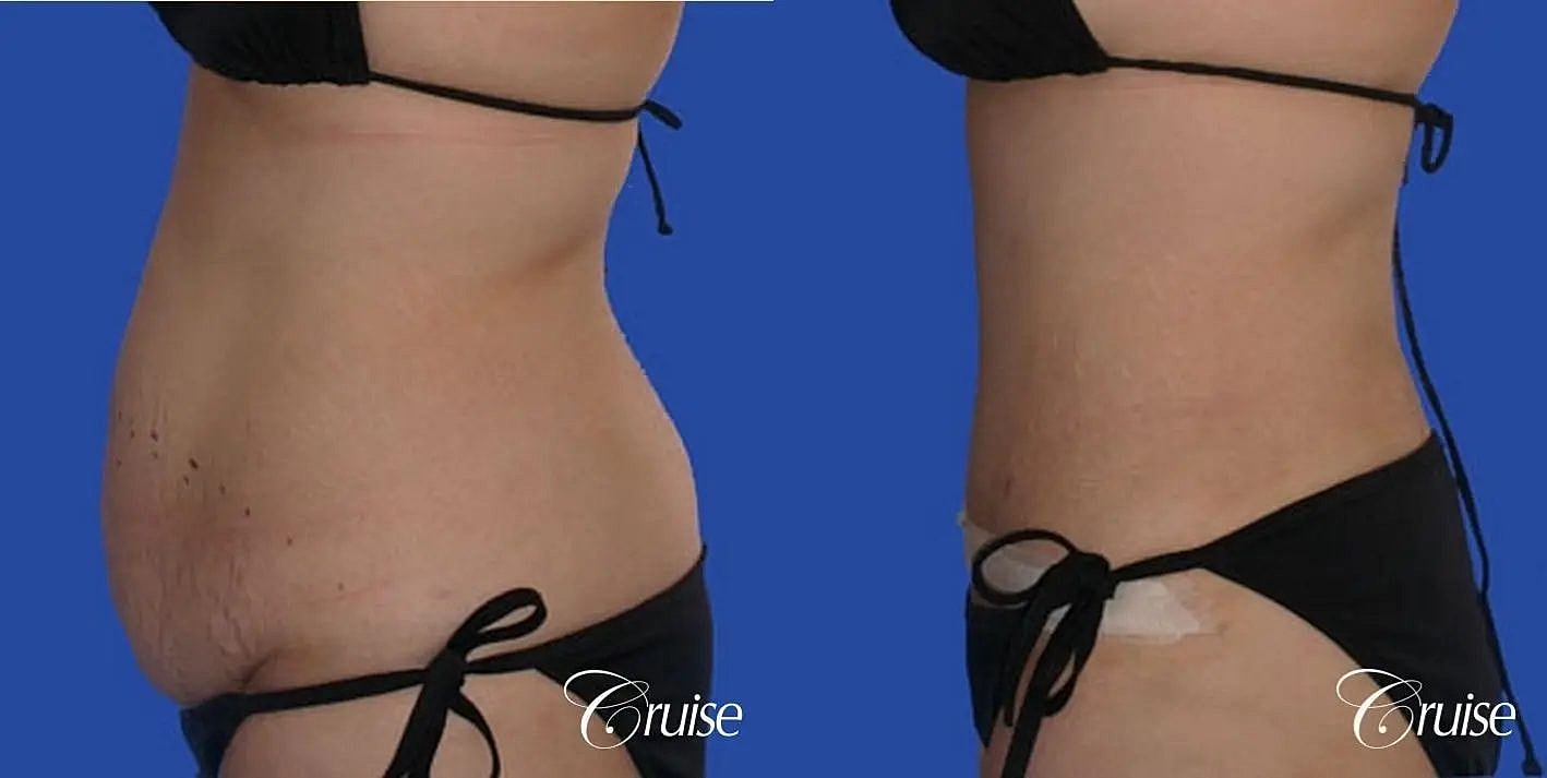Tummy Tuck Before & After