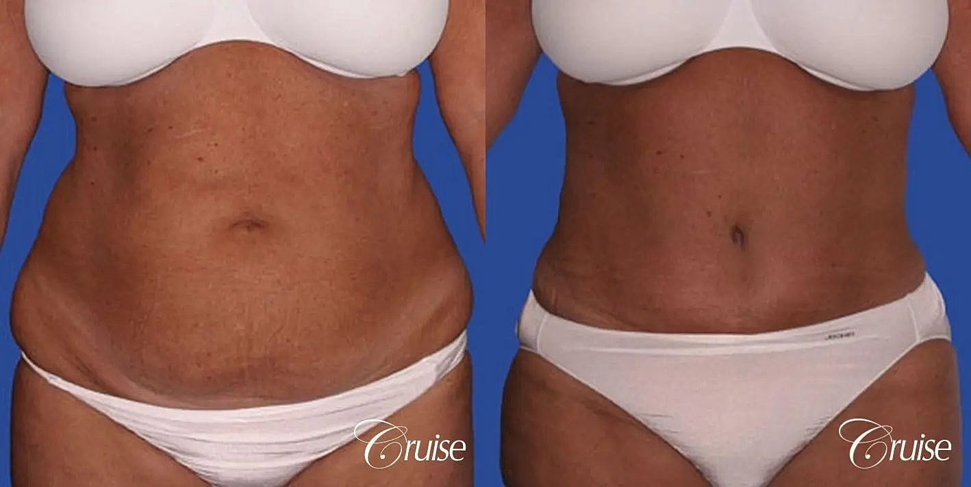 Tummy Tuck Before & After