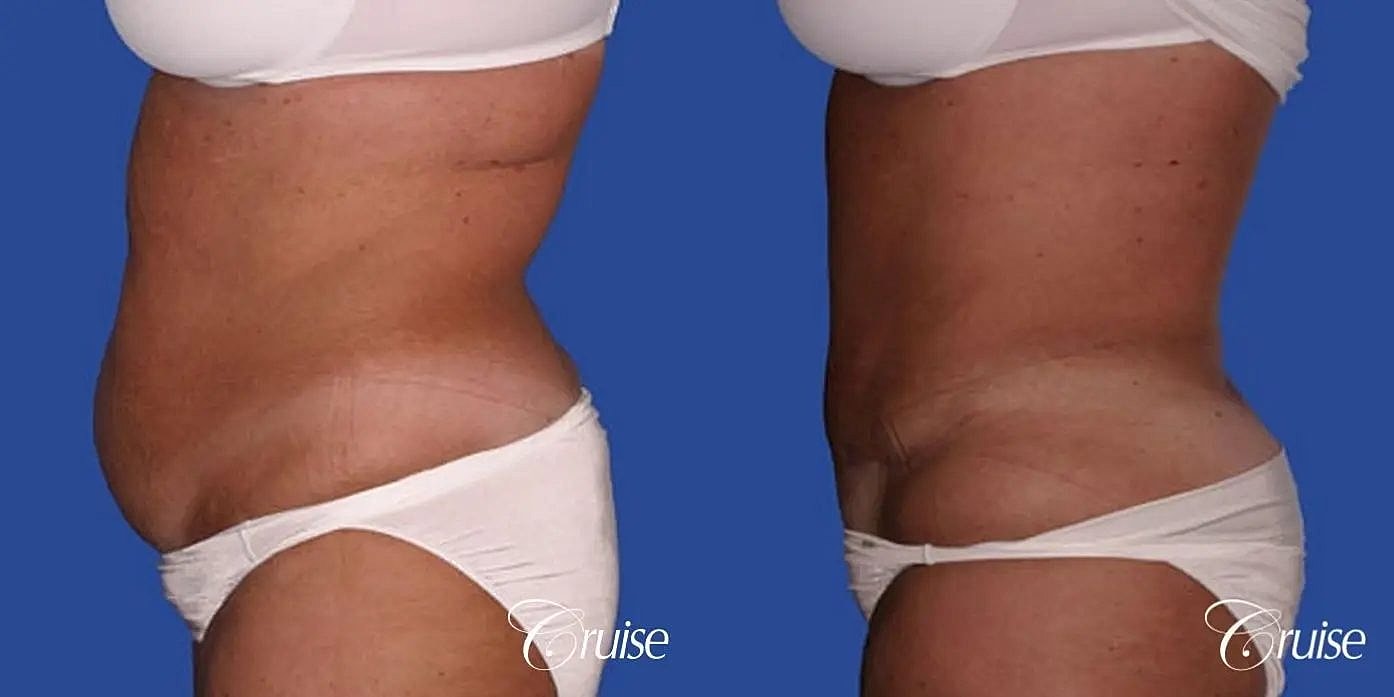 Tummy Tuck Before & After