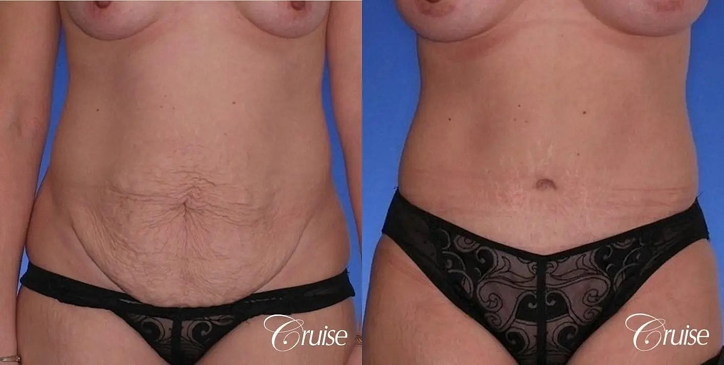 Tummy Tuck Before & After