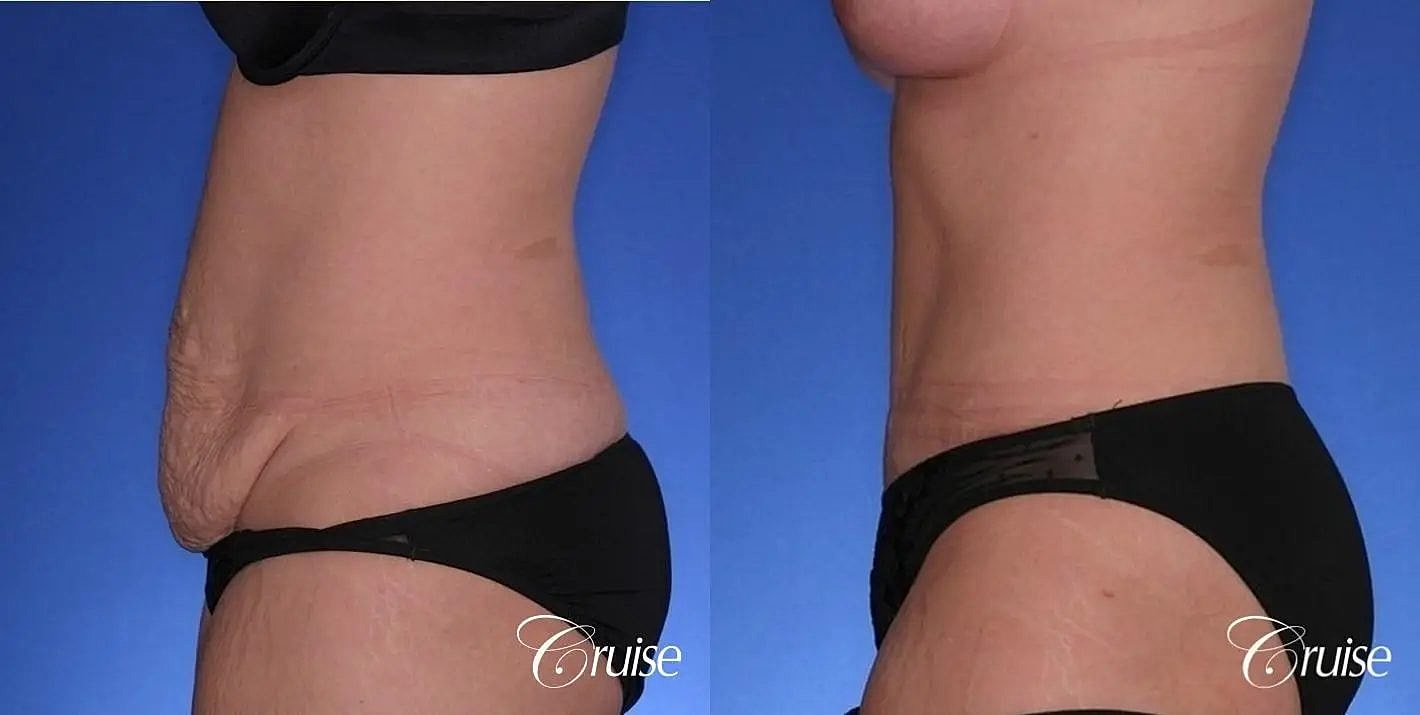 Tummy Tuck Before & After