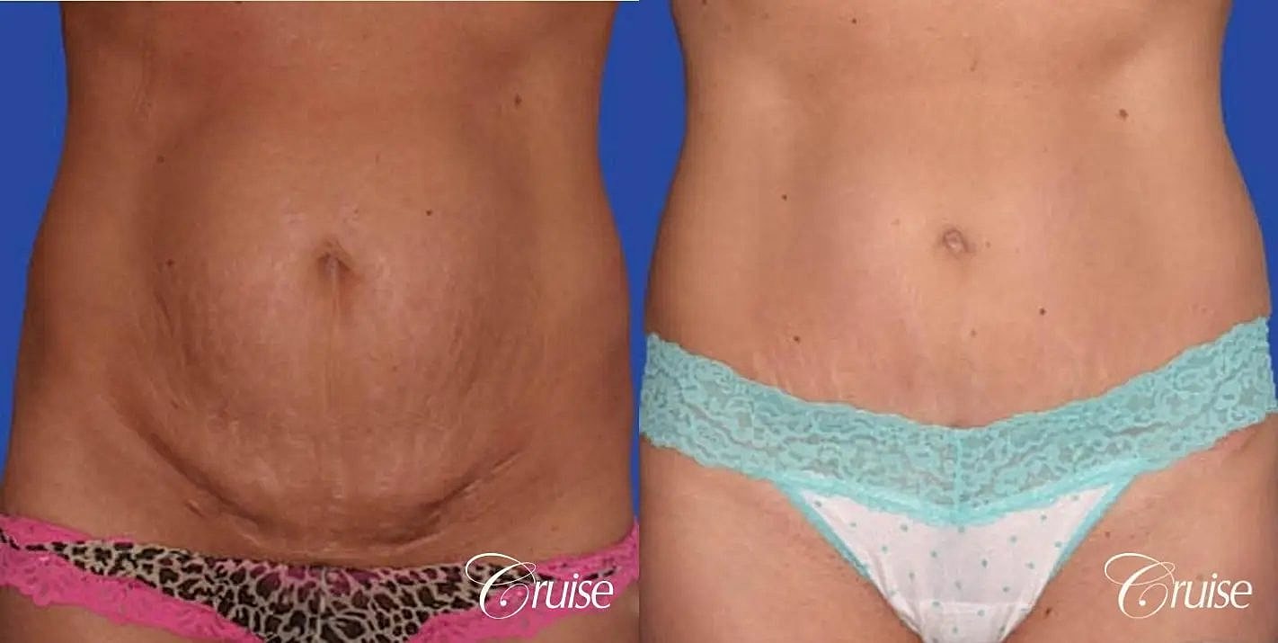 Tummy Tuck Before & After