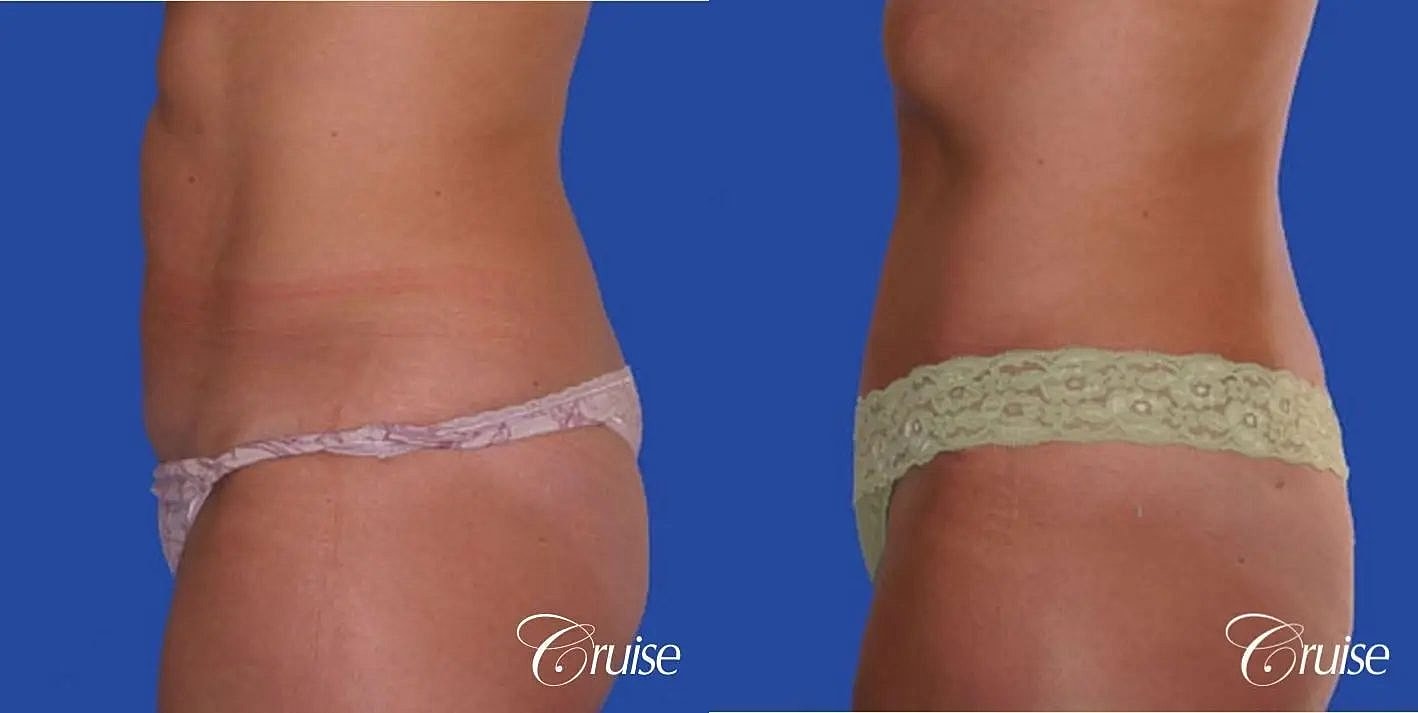 Tummy Tuck Before & After